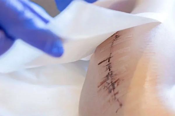 Postoperative Protective Waterproof Skin Colored Scar Patch